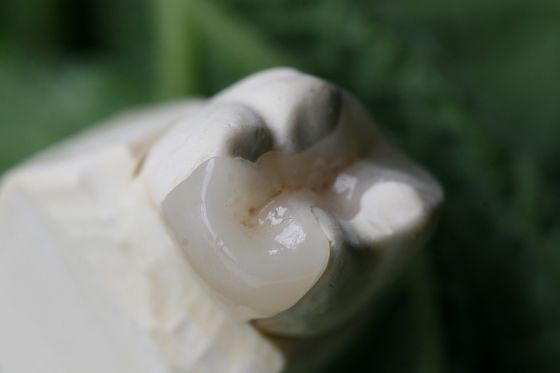 Corona dentaria artificiale estetica dell'intarsio e del parte sovrapposto in rilievo EMAX