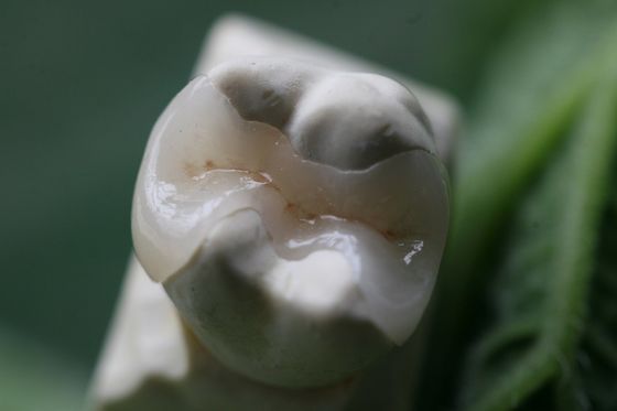 Corona dentaria permanente della soluzione EMAX di protesi fissa