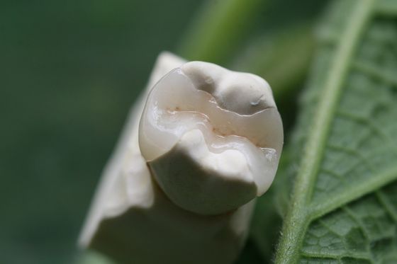 Corona dentaria permanente della soluzione EMAX di protesi fissa