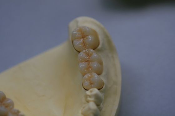 Corona dentaria del laboratorio di zirconio dell'ossido di biossido di zirconio dentario della porcellana con ceramico
