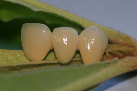 Corona temporanea composita di colore naturale della resina per i denti anteriori