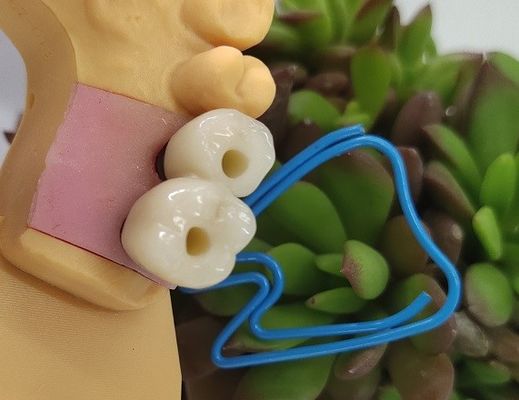 Gli impianti dentari di Endosseous incoronano