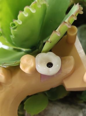 Gli impianti dentari cementati NOBEL BIOCARE della soluzione incoronano