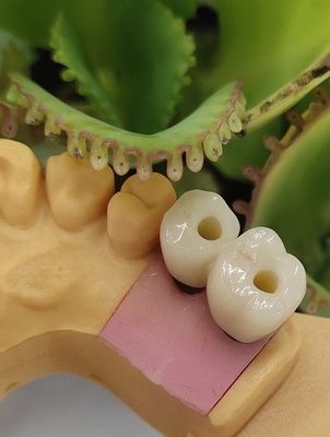 Gli impianti dentari cementati NOBEL BIOCARE della soluzione incoronano