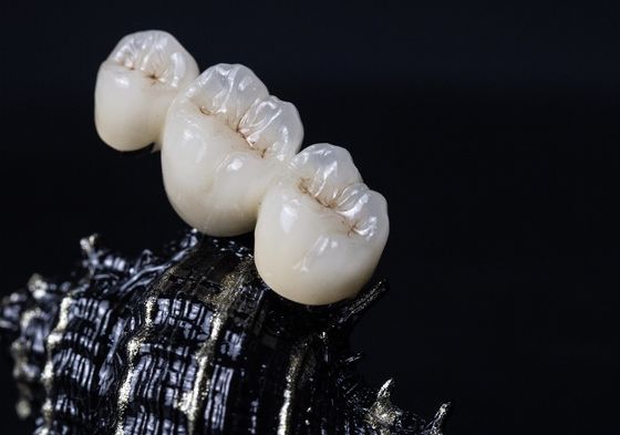 Corona dentaria della struttura PFM del metallo