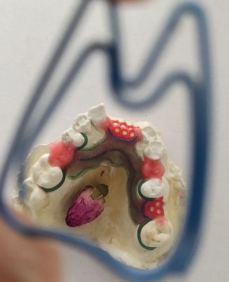 Struttura parziale del metallo della protesi dentaria di Co del Cr