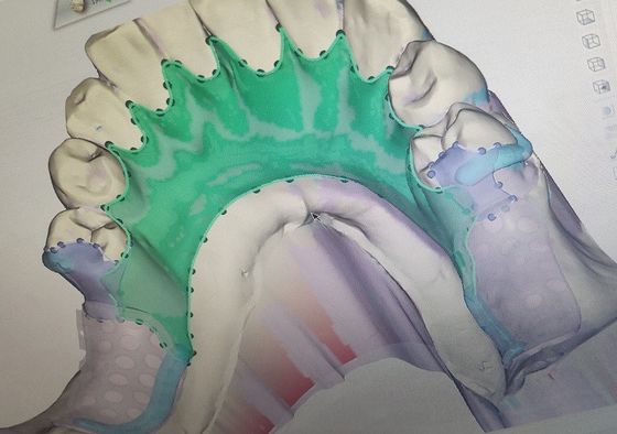 3D smontabile ha stampato la struttura parziale del metallo della protesi dentaria
