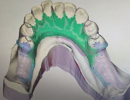 3D smontabile ha stampato la struttura parziale del metallo della protesi dentaria