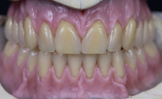 Protesi dentaria piena acrilica smontabile curata calda dell'arco pieno