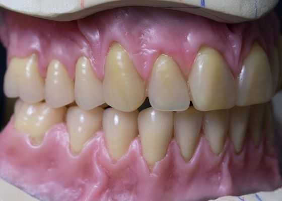 Protesi dentaria piena acrilica smontabile curata calda dell'arco pieno