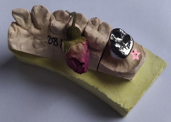 Il metallo base fuso pieno unisce in lega la corona dentaria