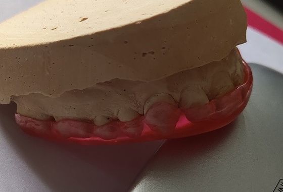 Guardia mascellare acrilica dura For Bruxism di stabilizzazione dell'arco