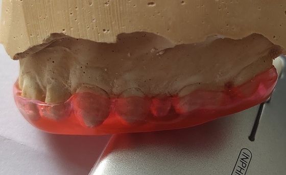 Guardia Trushine Bite Plane del Michigan per la molatura dei denti