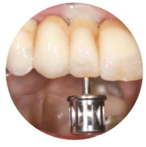 Il CSA naturale ha inclinato il Manica che della vite gli impianti dentari incoronano