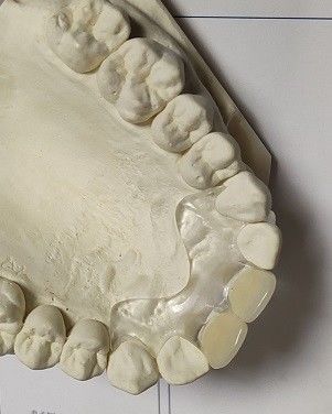 Protesi dentaria invisibile molle comoda di misura ISO13485 RPD