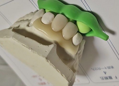 Protesi dentaria invisibile libera del metallo della resina per il paziente allergico