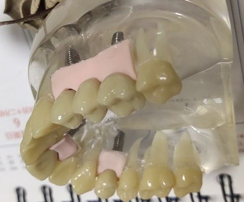 100 corona provvisoria di biocompatibilità PMMA di per cento