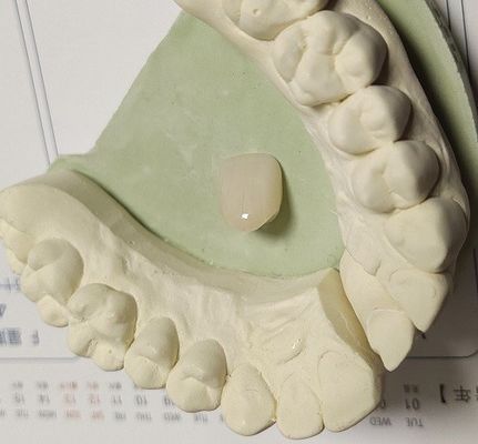 Corona temporanea composita di colore naturale della resina per i denti anteriori