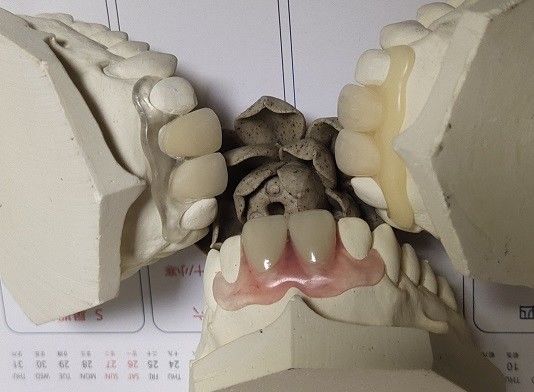 Protesi dentaria invisibile flessibile parziale per i denti anteriori