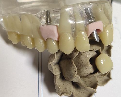 Spazio in bianco del metallo che macina la stampa dentaria 3D della corona interna di PFM