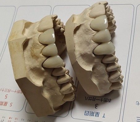 Corona di camma PFM della porcellana cad