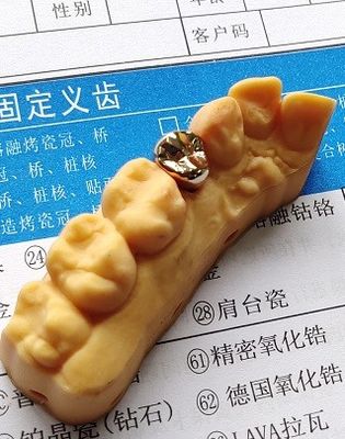 Alta corona dentaria preziosa del legha d'oro di buona forma fisica
