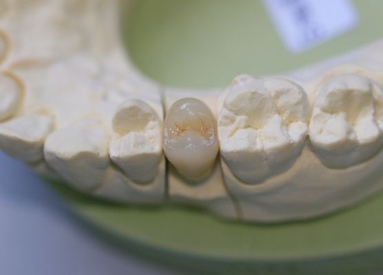 Corone posteriori ceramiche di vetro di Aesthethics EMAX per i molari