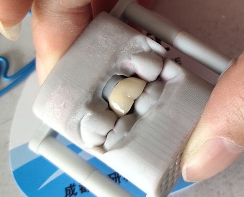 Corona dentaria della corona 3D del laboratorio PFM del ponte dentario di stampa