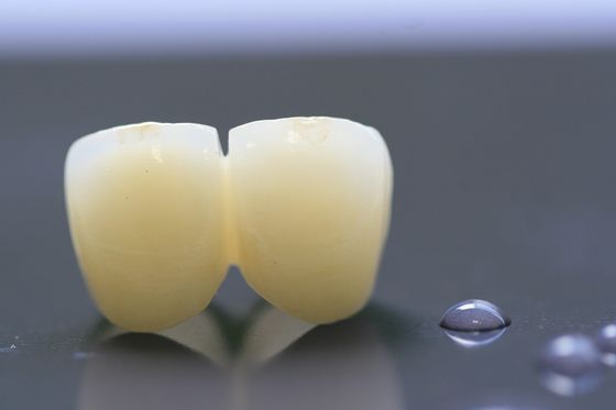 corona dentaria del laboratorio della struttura PFM della stampa 3D per odontoiatria