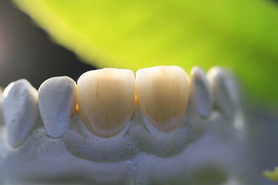 corona dentaria del laboratorio della struttura PFM della stampa 3D per odontoiatria