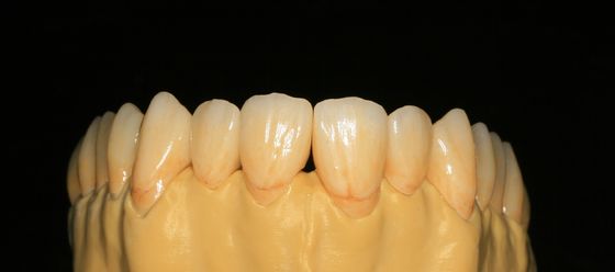 Il laboratorio dentario ha riparato la protesi ha messo a strati la corona dentaria di biossido di zirconio per Front Teeth