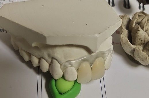 Protesi dentaria invisibile molle ed elastica temporanea di Valplast