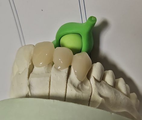Il metallo ha basato la corona temporanea ibrida composita di PMMA