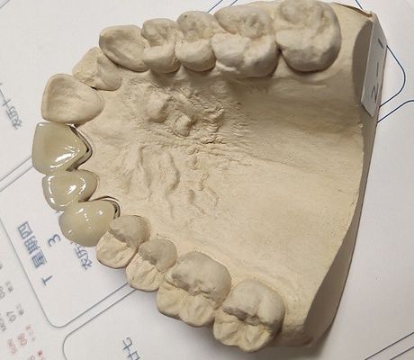 Buona corona dentaria metal-ceramica di forma fisica PFM