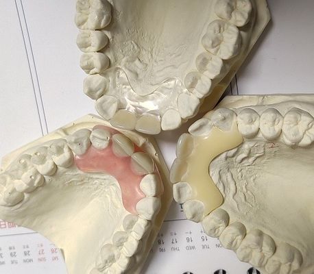 Protesi dentaria invisibile libera del metallo della resina per il paziente allergico