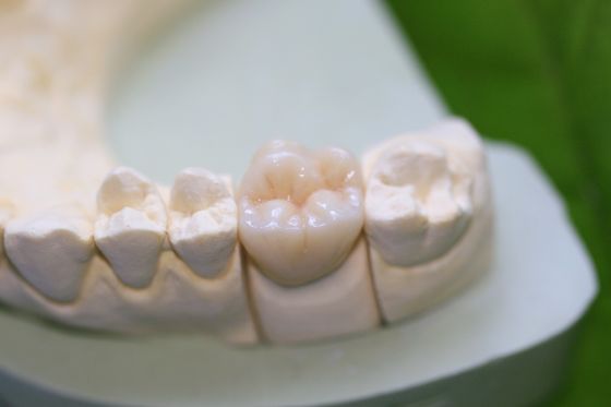 Corone posteriori ceramiche di vetro di Aesthethics EMAX per i molari